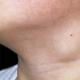 Воспаление лимфоузлов на шее — домашнее лечение