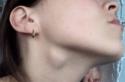 Причины увеличения лимфоузлов на шее: лечение